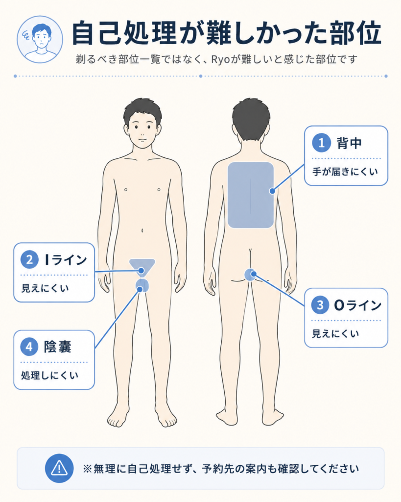 Ryoが全身脱毛前の自己処理で難しいと感じた部位