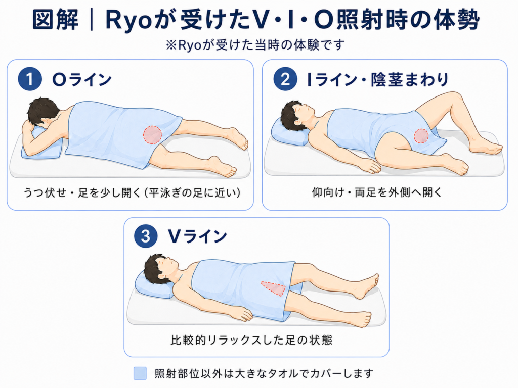 Ryoが実際に受けたメンズVIO脱毛のVライン・Iライン・Oライン照射時の体勢